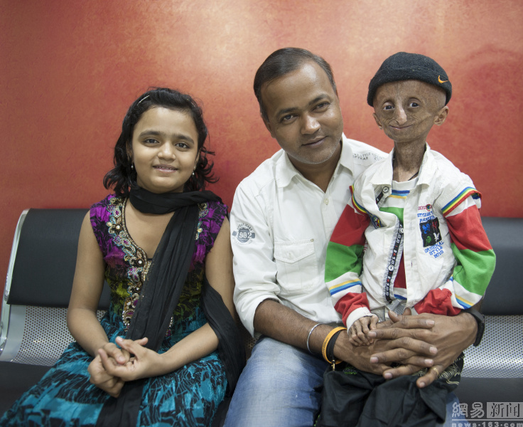 印度早衰症男孩庆祝15岁生日(5)